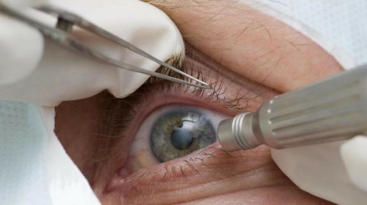 Número de exames oftalmológicos no SUS dobra em relação a 2020